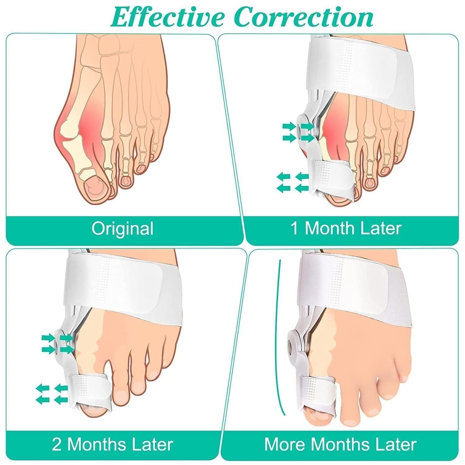 Silicone Toe Separator For Adults Bunion Corrector Splint Kit For Toe r3fvcs-m6