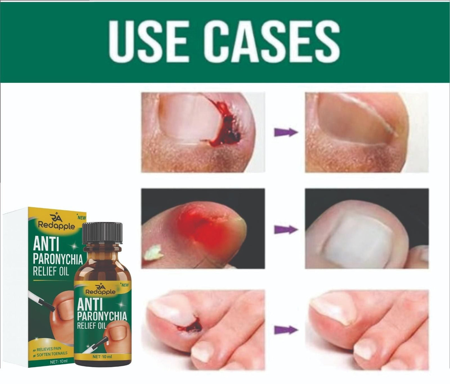 Anti Paronychia Relief Oil 20 ml Pack of 2 r3fvcs-m6