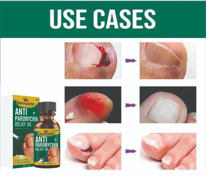 Anti Paronychia Relief Oil 20 ml Pack of 2 r3fvcs-m6